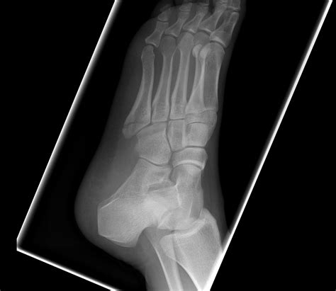 Metatarsal Fractures The Bone School