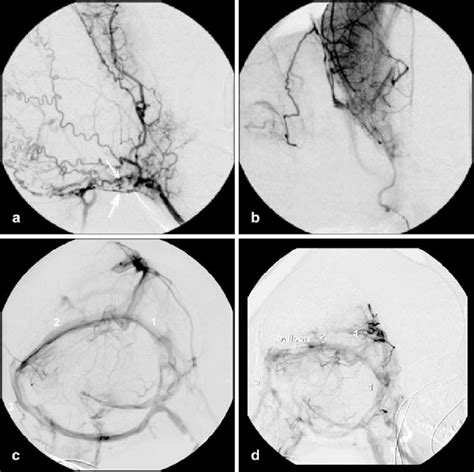 A Digital Subtraction Angiography Dsa With Contrast Injection In The