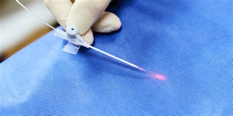 Endovenous Laser Ablation Varicose Vein Removal