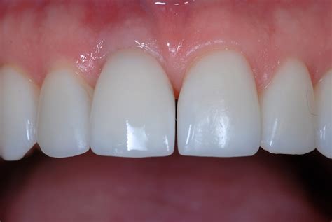 Single Anterior Crown Implant Rick Glassman Dds Maafe