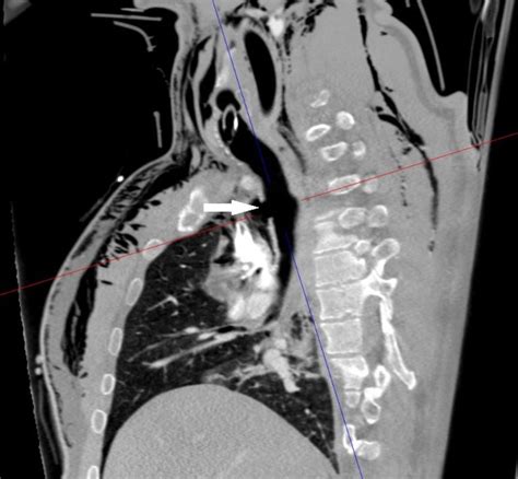 Ct Scan Sagittal Reconstruction Complete Transection Of The