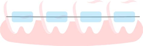 Conventional Braces - NoFrills Dental