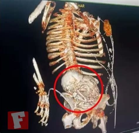 Beb De Pedra Idosa De Anos Descobre Feto Calcificado Que