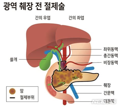 온종합병원 췌장암 말기 혈관합병절제술로 암세포 완전 제거