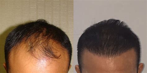 Hair Transplant In Dubai Uae Dubai Cosmetic Surgery Clinic