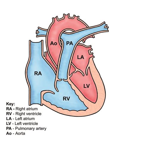 Congenitally Corrected Transposition Of The Great Arteries Cctga