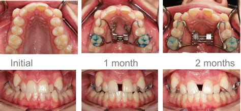Palate Expander After Braces At Harry Ricks Blog