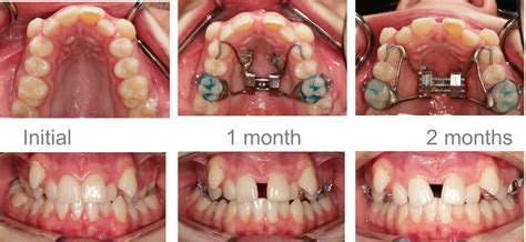 Do Rubber Bands Fix Crossbite At Kristine Wilkinson Blog