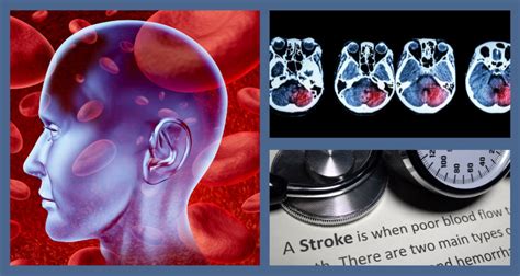 3 Types Of Strokes Causes Symptoms Treatment