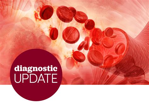 Challenges With Diagnosing Paroxysmal Nocturnal Hemoglobinuria - Rare ...