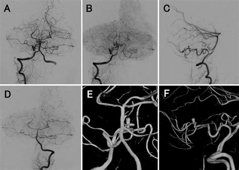 Preoperative Dsa Anteroposterior A And B And Lateral C Right