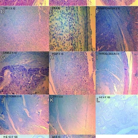 Pathological Images From Cervical Lymph Node Resection Total Download Scientific Diagram