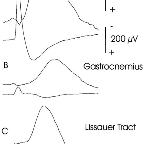 Interaction between stimuli to Lissauer tract and to either nerve to ...