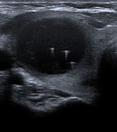 Thyroid Ultrasound Cyst