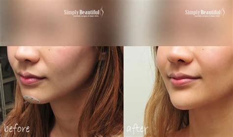 Nose Filler Injection Dr Peter Kim Surgery Skin Cancer Cosmetic