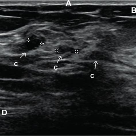 Stepladder Sign Transverse Ultrasound Demonstrates An Intracapsular Download Scientific