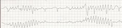 ACLS Review Wide Complex Tachycardia WCT Part 8