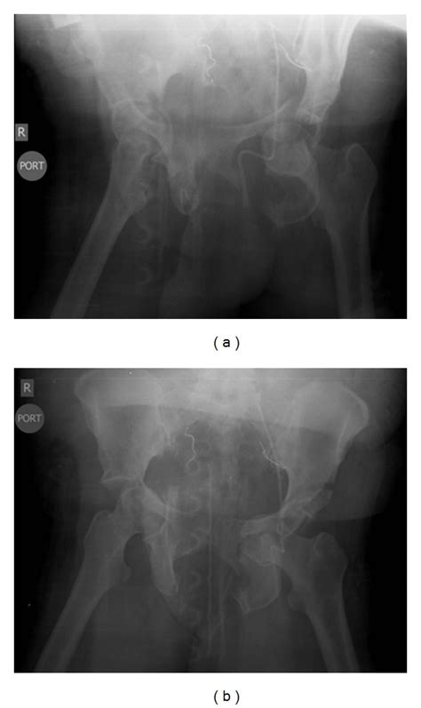 A Anterior Posterior Radiographic Image Of Pelviscourtesy Of The