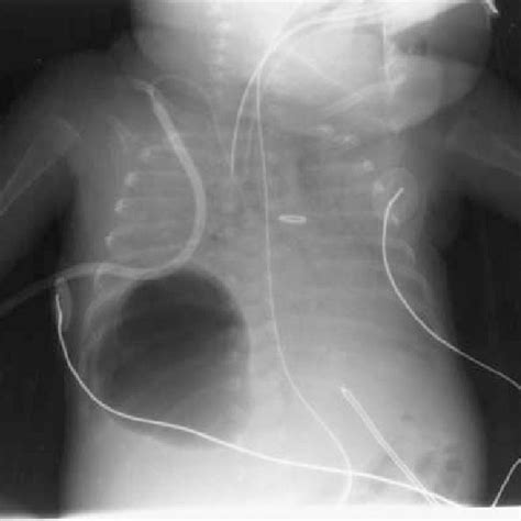 (PDF) Percutaneous Catheter Evacuation of a Pneumatocele in an ...