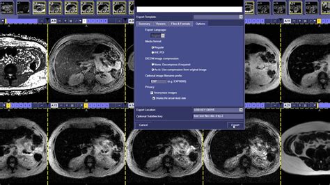 How To Read A Iron Quantification Mri Youtube