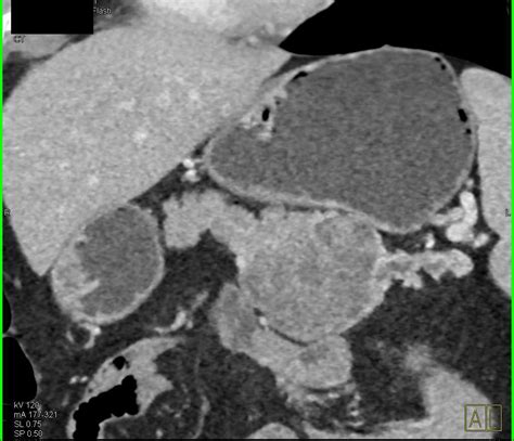 Serous Cystadenoma Tail Of Pancreas With Dilated Distal Duct Pancreas