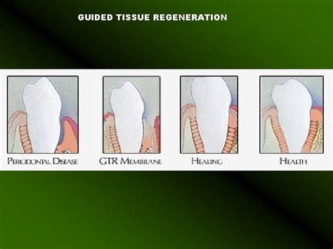 Guided Tissue Regeneration And Guided Bone Regeneration Guided