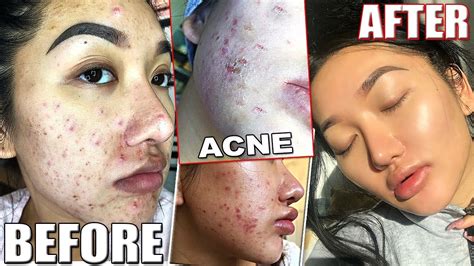 My Acne Story Accutane Journey For The Second Time Side Effects