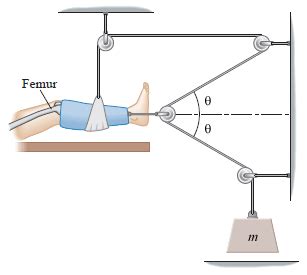 A Young Boy With A Broken Leg Is Undergoing Traction. ... | Chegg.com