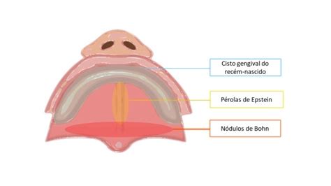 Cisto Gengival Do Adulto - Cisto Gengival do Adulto - Patologia Bucal