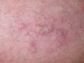 Punteggio EASI Dermatly Il Tuo Sito Sulla Pelle