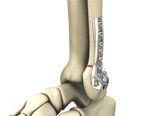 Ankle Fracture Repair Los Angeles Broken Ankle Glendale Pasadena