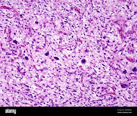 Undifferentiated Pleomorphic Sarcoma Light Micrograph