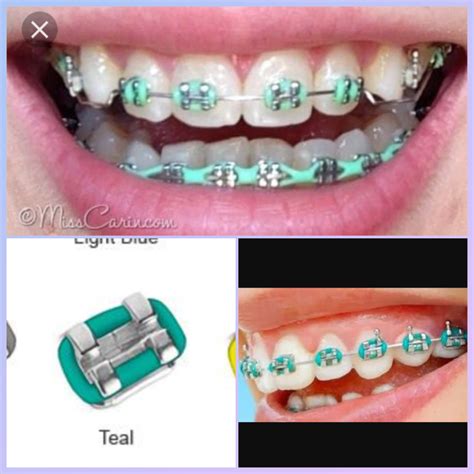 √ Braces Color Teal