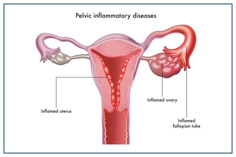 Pelvic Inflammatory Disease Symptoms Causes And Treatment