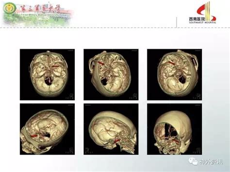 颅脑创伤 神经重症病例周刊（第10期） 颅面开放性损伤多学科处理一例 脑医汇 神外资讯 神介资讯