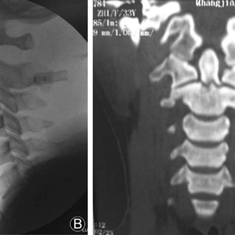 The Postoperative Anteroposterior A And Lateral B Radiographs