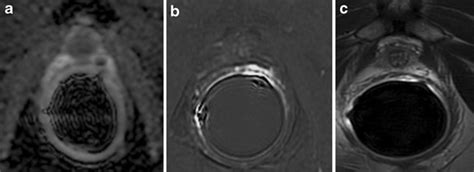 4 Mispositioned Endorectal Coil A Adc Map Dwi Acquired With B Value Download Scientific