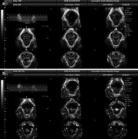 Further Investigations And Follow Up Pelvic Floor Ultrasound