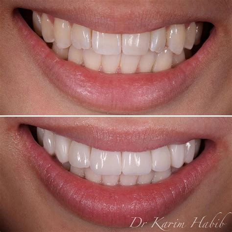 Composite Veneers Sydney Dental Bonding Sydney Dentist Ryde