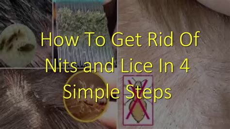 How To Get Rid Of Nits And Lice In 4 Simple Steps Youtube