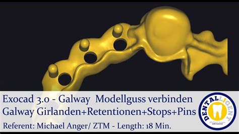 2021 Exocad 3 0 Tutorial Galway Modellguss Verbinden Galway Girlanden