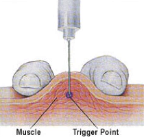 Superficial And Deep Dry Needling