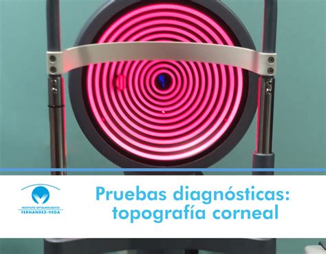 Pruebas diagnósticas topografía corneal qué es y para qué sirve