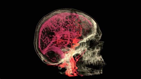 Blood Vessels Of The Brain, Mri Photograph by Anatomical Travelogue ...