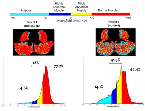 Illustration Of Variation In Muscle Radiodensity