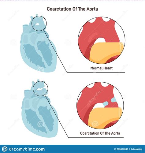 Patent Ductus Arteriosus With Normal Heart Anatomy Illustration Of The