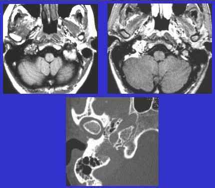 Gamma Knife for Glomus Tumors