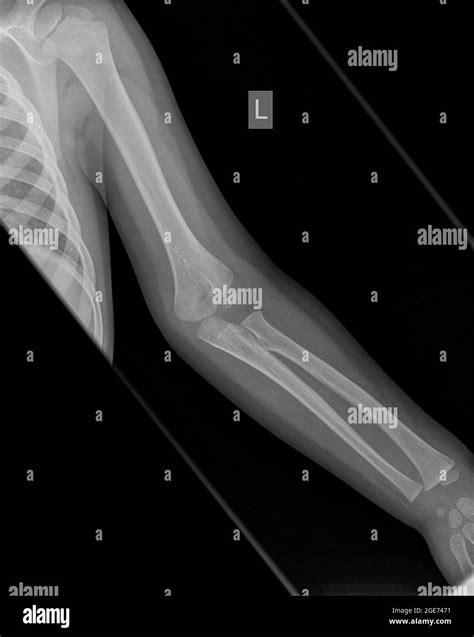 Supracondylar Fracture Fat Pad