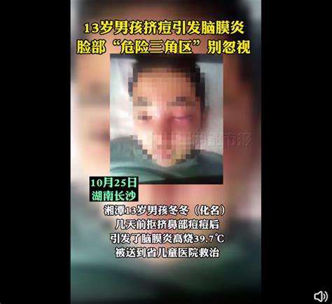 别乱抠痘！13岁男孩挤痘引发脑膜炎：面部“危险三角区”不要随便碰 新闻频道 和讯网