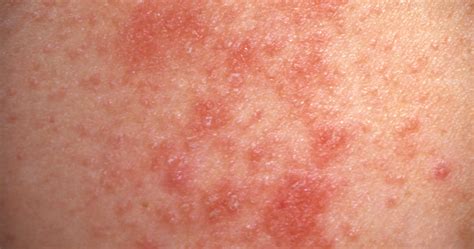 Prickly Heat Rash Treatments Causes And More 43 Off